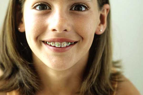 Σιδεράκια και γιορτές: Τι μπορείτε να τρώτε, τι πρέπει να προσέχετε 